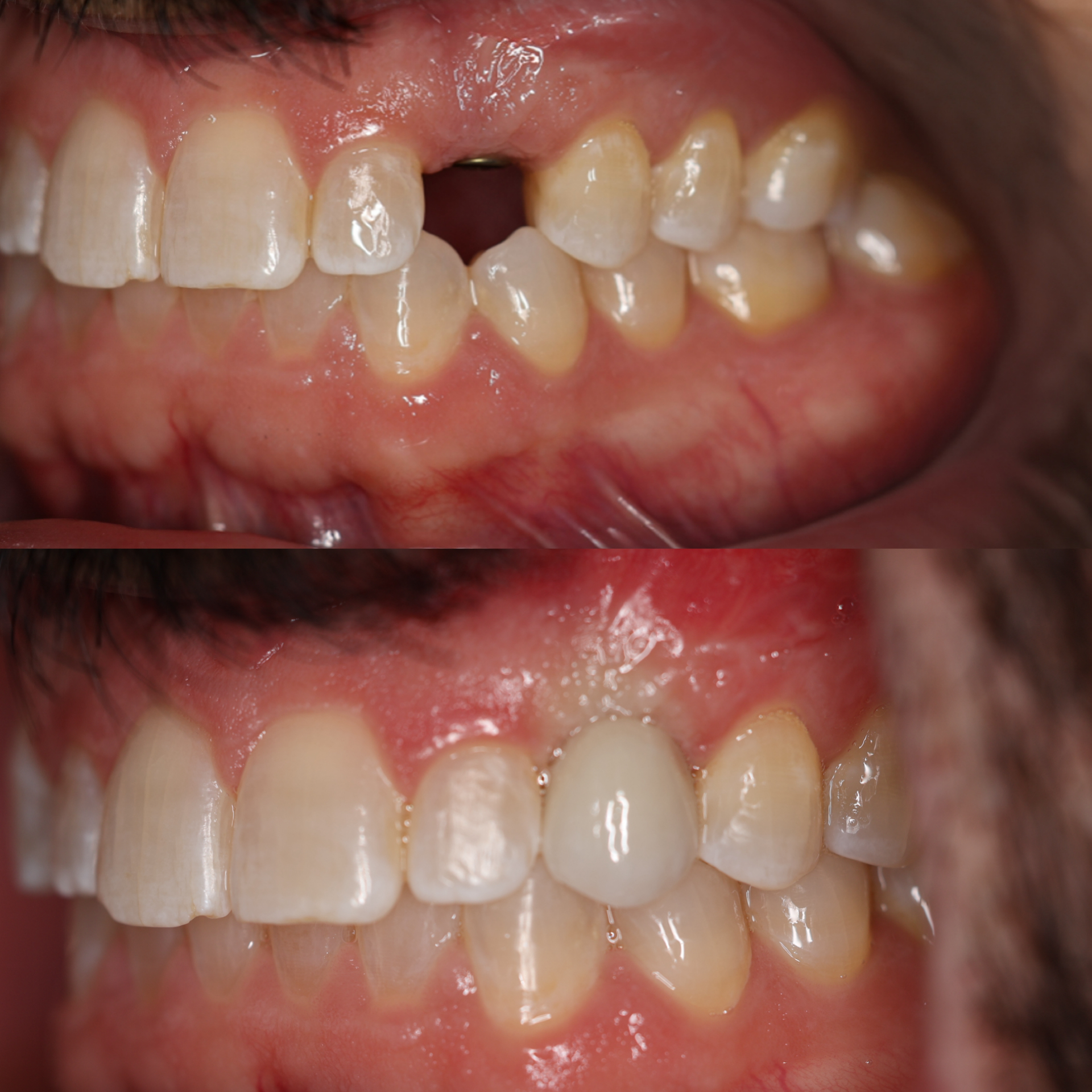 Dental Implant Astoria