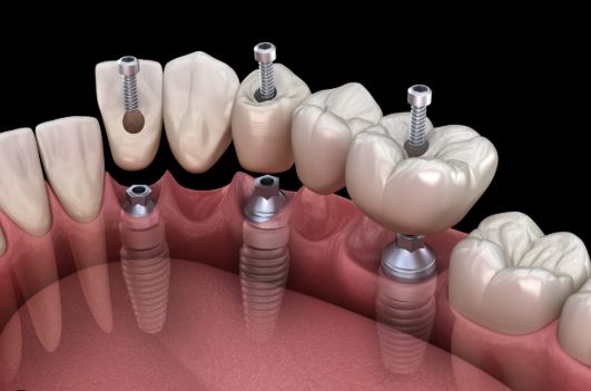 Dental Implants Yonkers